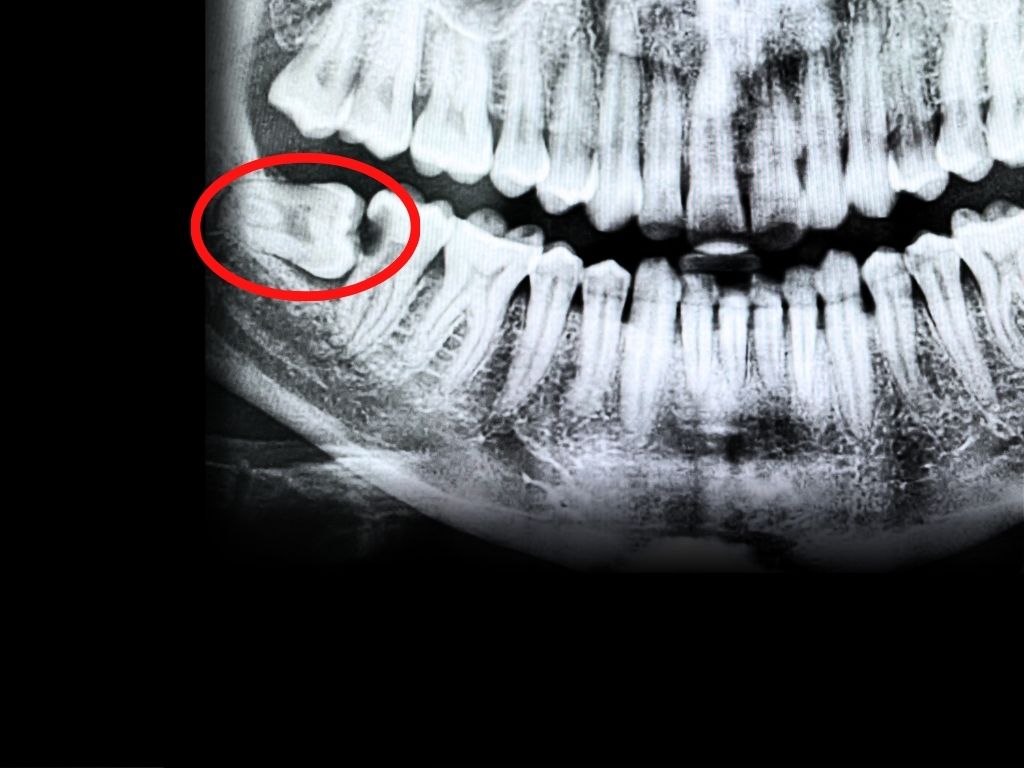 Before transformation